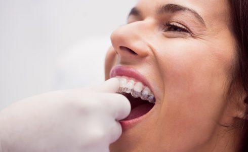 Dentista colocando alineador invisible a paciente