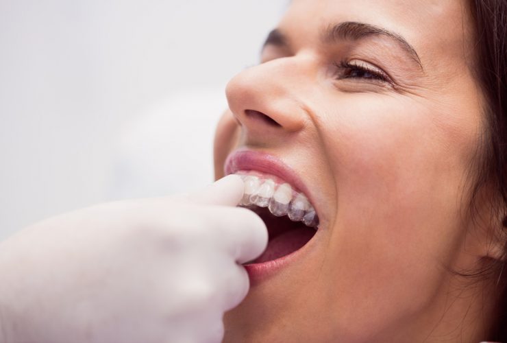 Dentista colocando alineador invisible a paciente