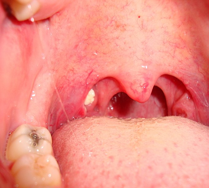 Medio Traducción oyente Tonsilolitos ¿Cómo eliminarlos? : Clínica Dental Dra. Cachero