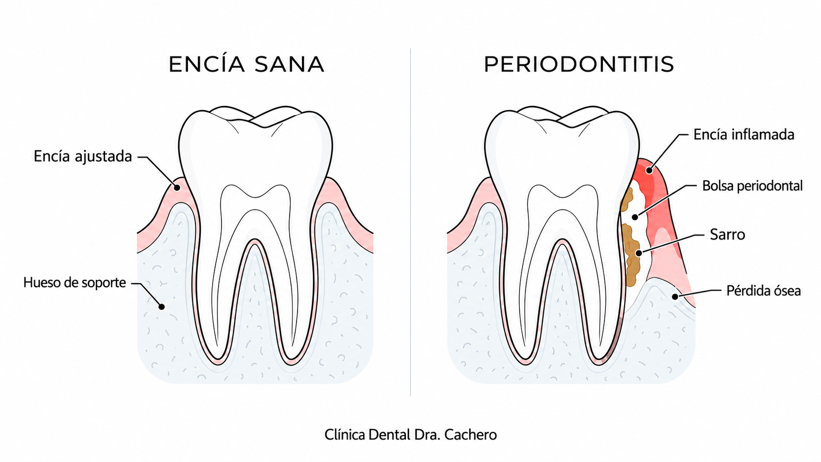 Comparación entre una encía sana y una encía con periodontitis, con bolsa periodontal y pérdida de hueso
