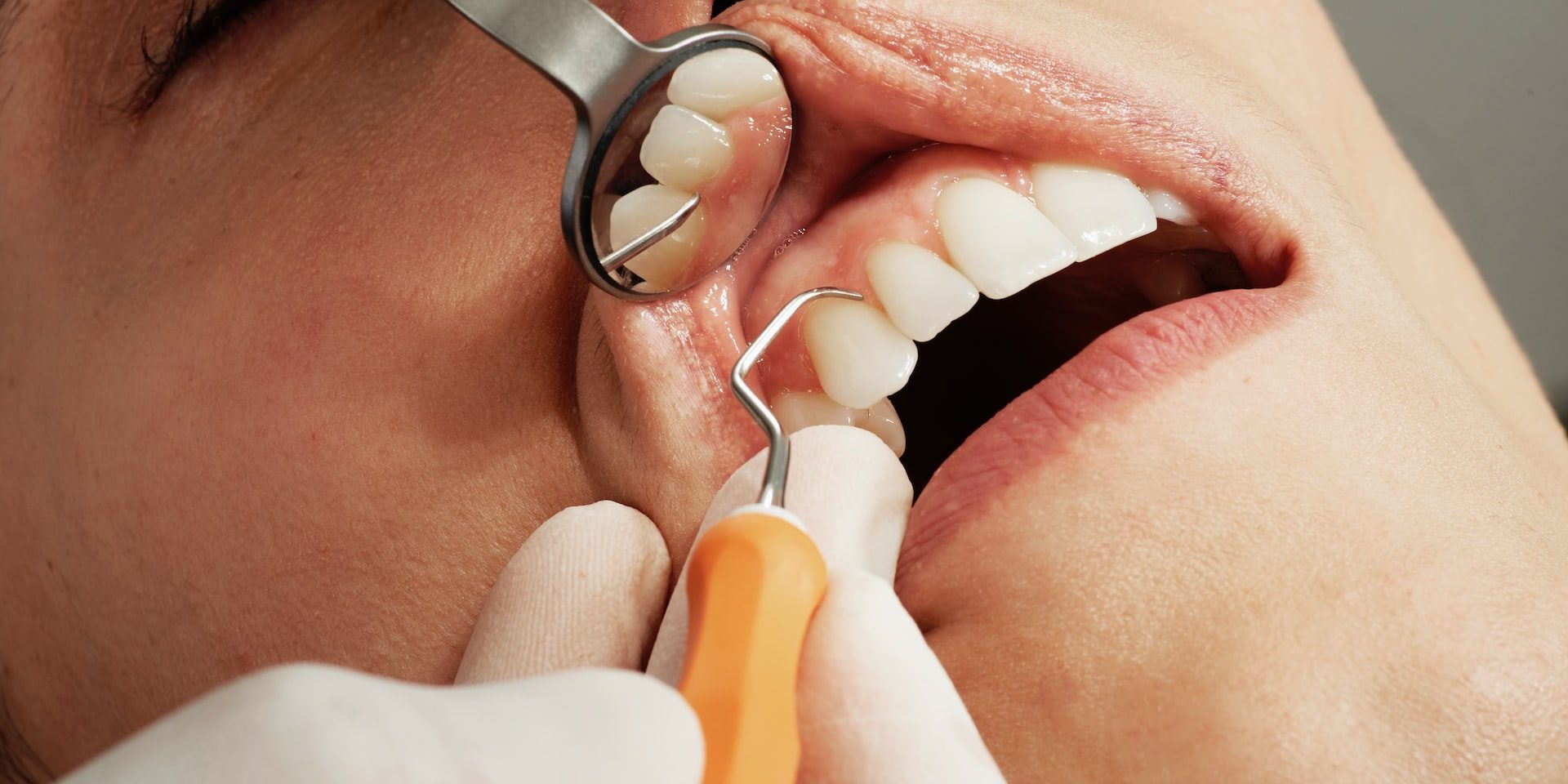 Prevención de la periodontitis