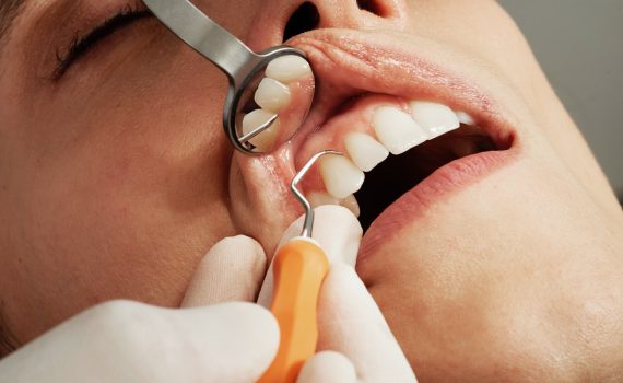 Prevención de la periodontitis