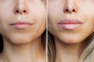 Relleno de labios con ácido hialurónico. Antes y después del tratamiento Relleno de labios con ácido hialurónico. Antes y después del tratamiento