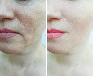 Antes y después del tratamiento con ácido hialurónico del surco nasogeniano Antes y después del tratamiento con ácido hialurónico del surco nasogeniano