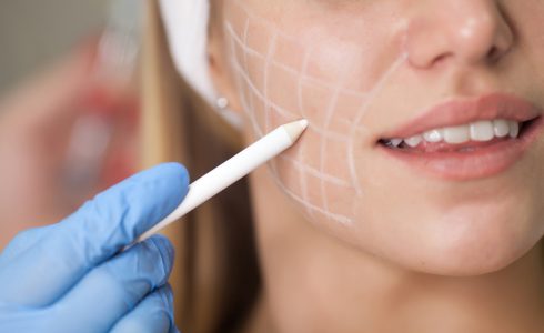 Tratamiento con ácido hialurónico en surco nasogeniano