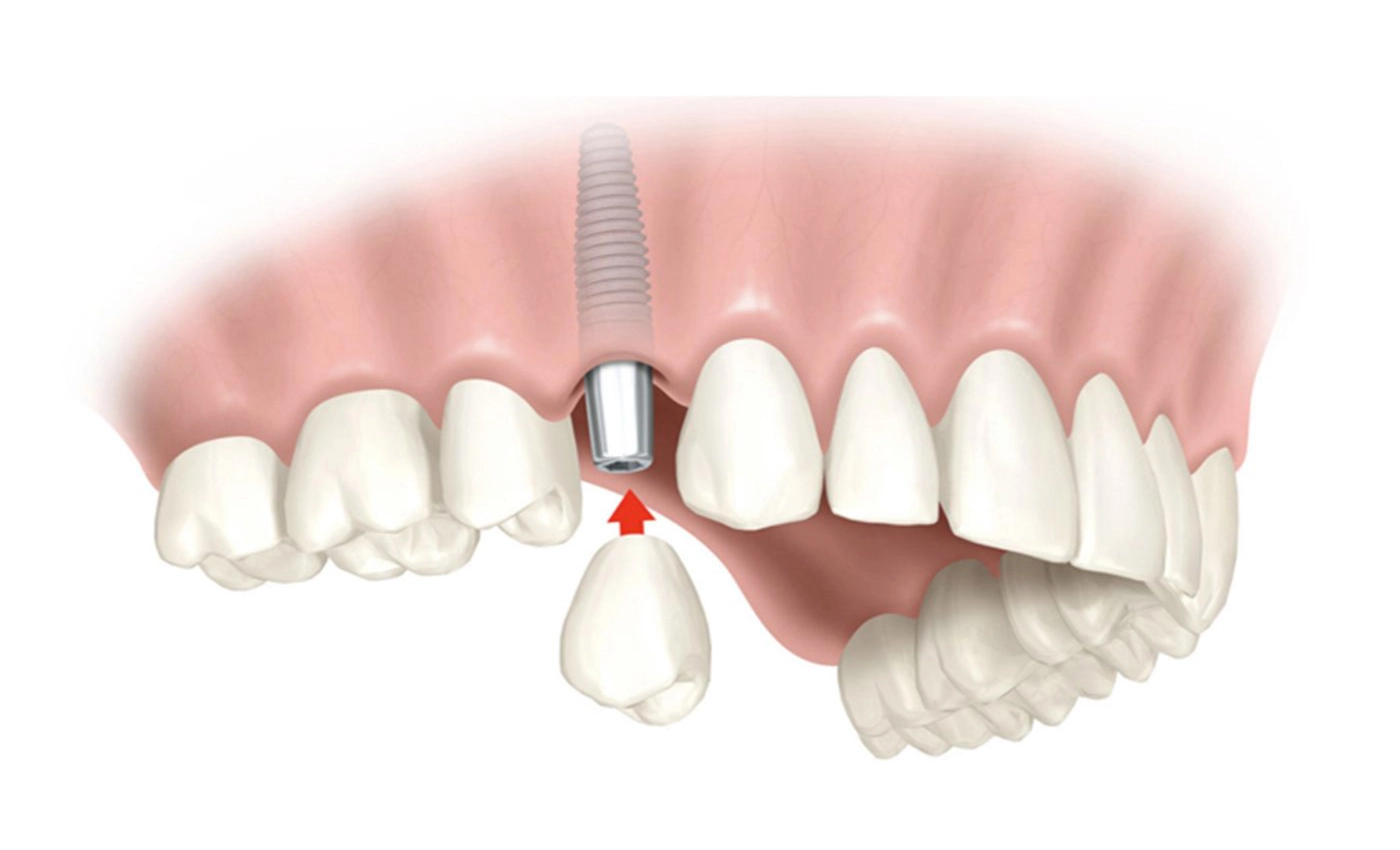 Implante dental unitario Implante dental unitario
