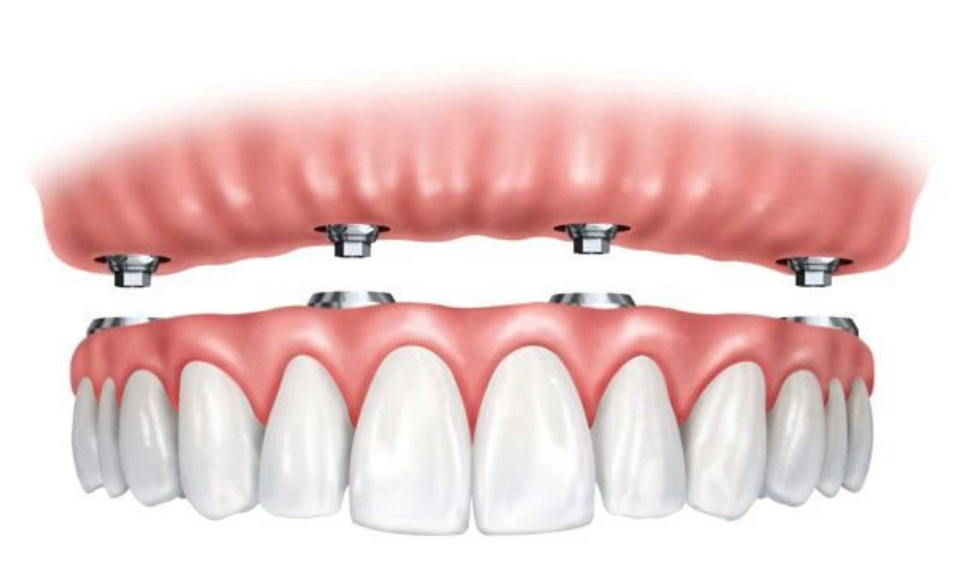 Prótesis sobre implantes Prótesis sobre implantes