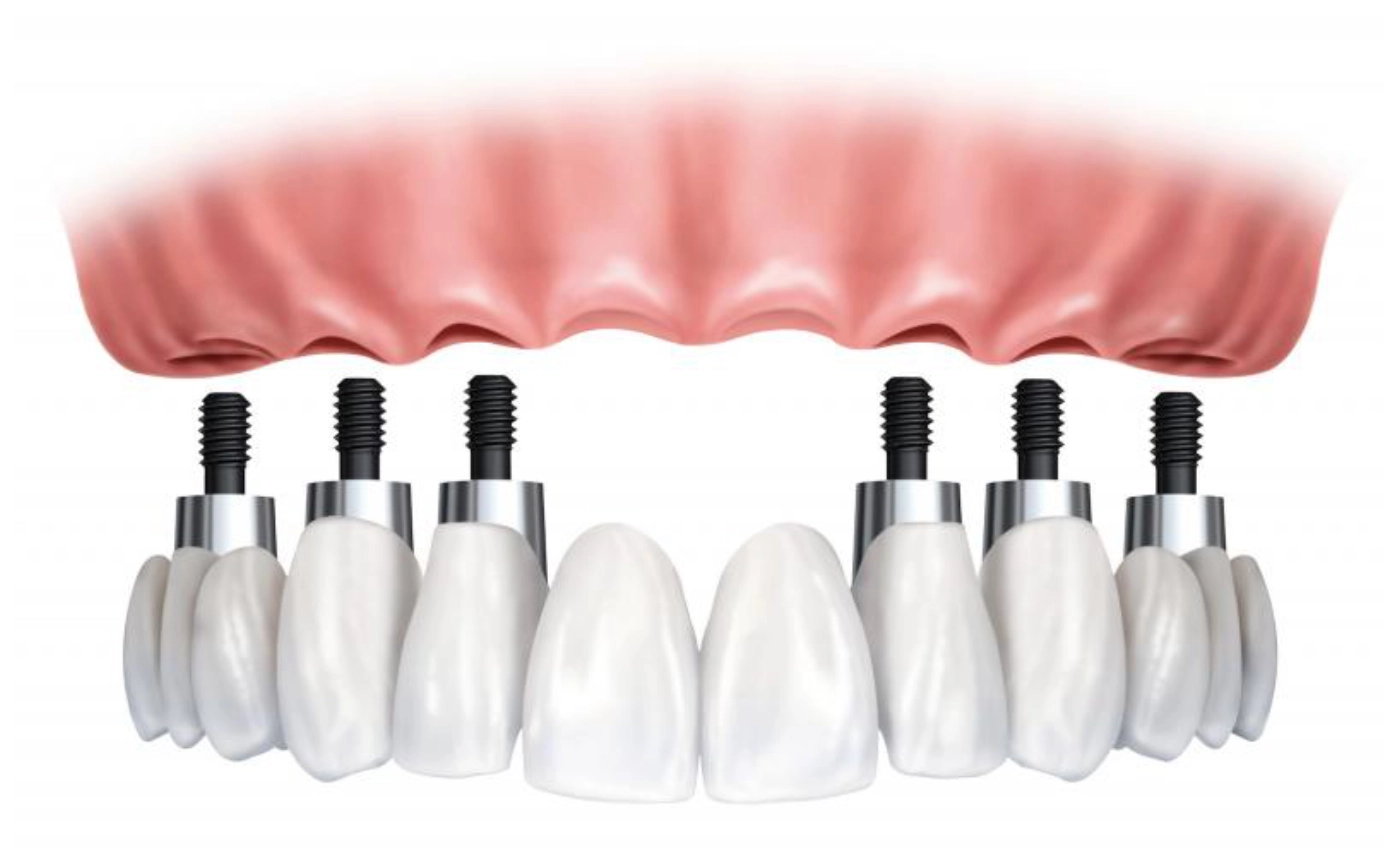 Prótesis dental fija Prótesis dental fija